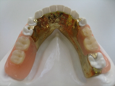 金属床義歯.JPG