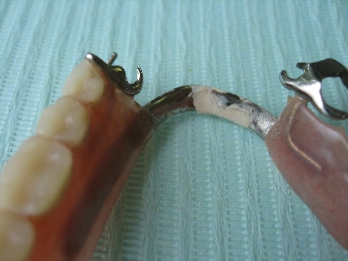 歯石.JPG