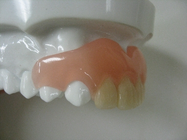 審美義歯１.JPG